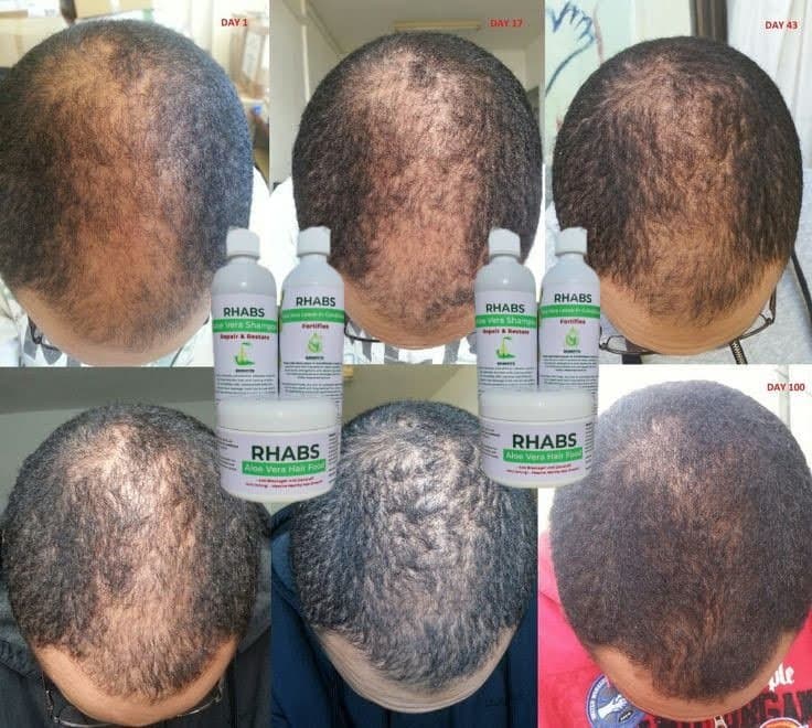 Rhabs Aloe Vera Hair Growth (Baldness Set)